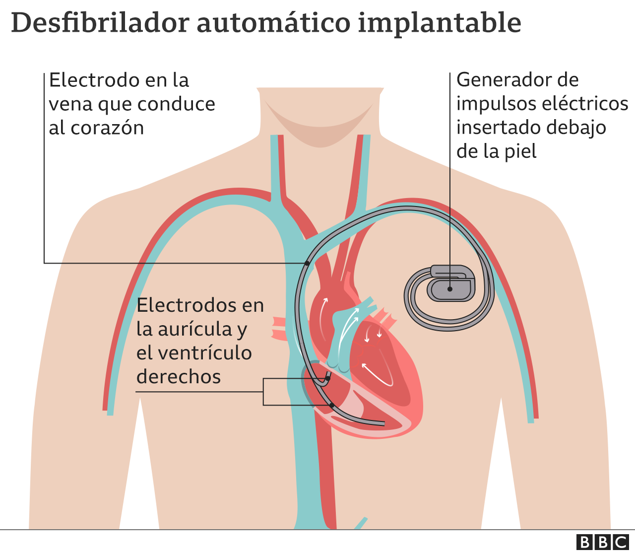Implantable cardioverter defibrillator graphic, also called implantable cardioverter defibrillator.