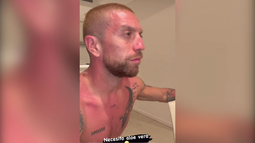 Video: Papu Gómez showed his sunburns